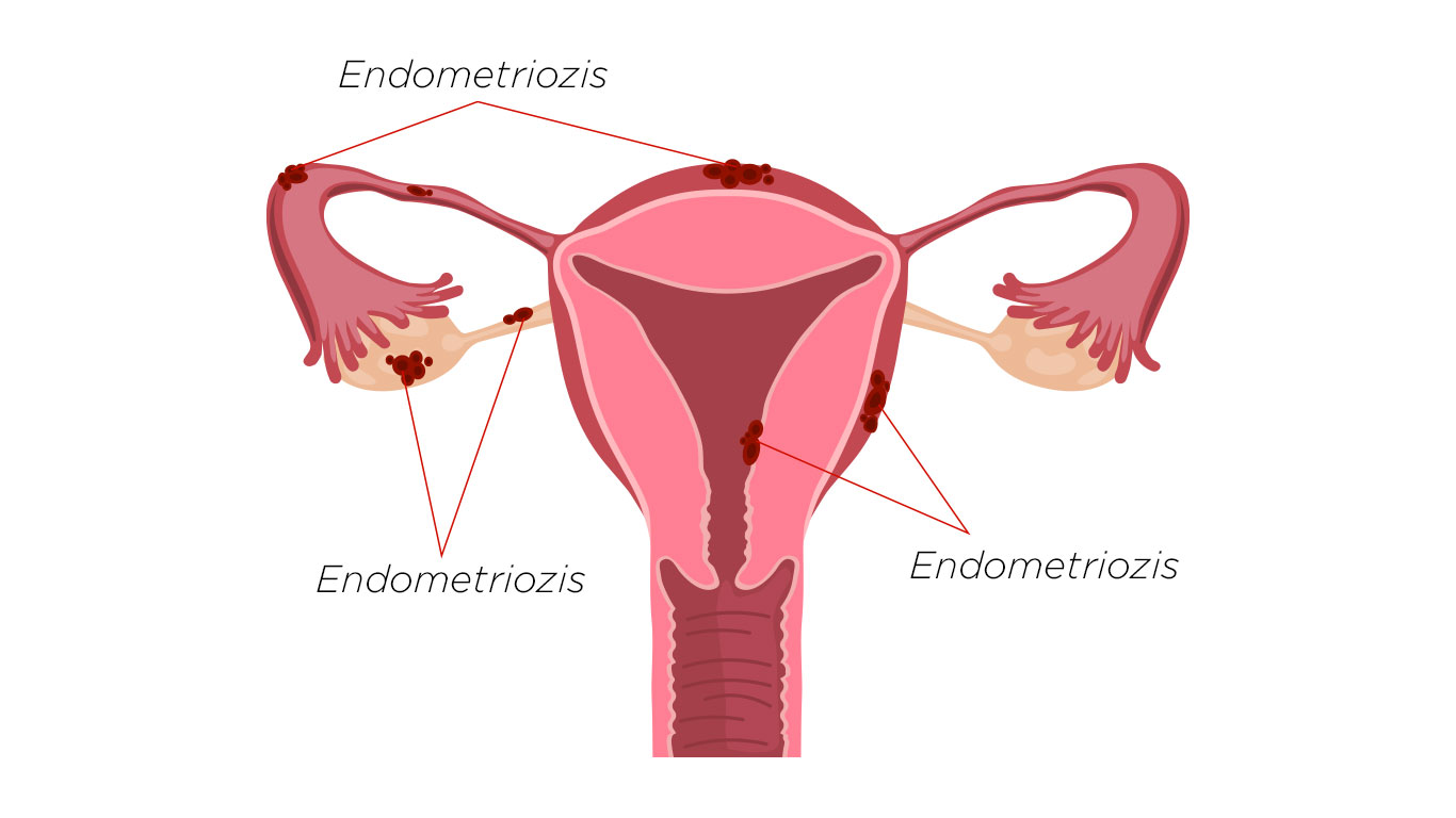 endometriozis tedavisi
